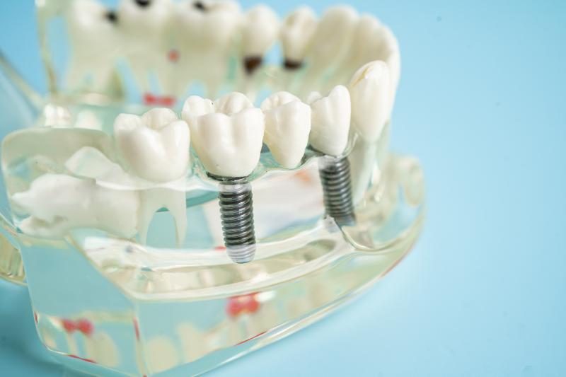 ¿Cuánto duran los implantes dentales?