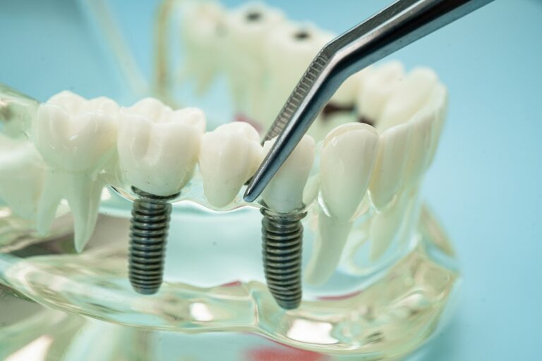 Prótesis sobre implantes en Santa Coloma de Gramenet