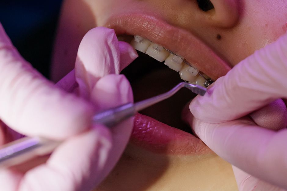 Cuánto dura un tratamiento de ortodoncia