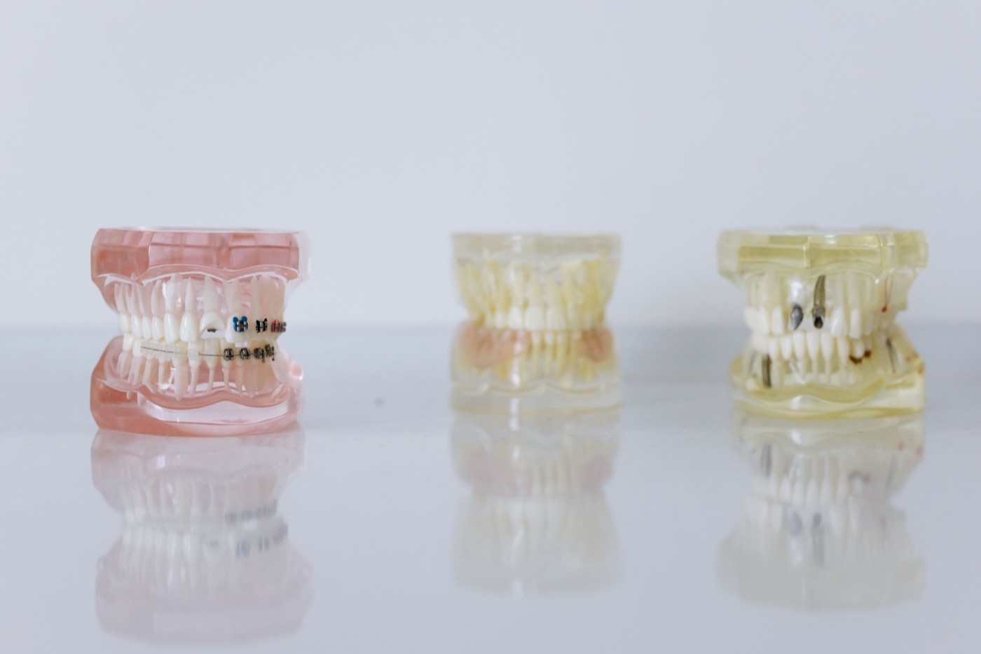 Tres modelos dentales sobre una mesa, uno de ellos con brackets metálicos